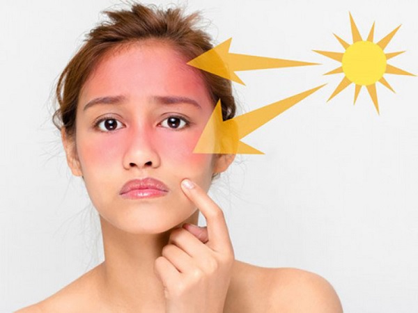 Nám nắng - nám do ánh mặt trời là một trong các loại nám da phổ biến - Adonai Viet Nam